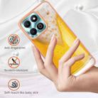 For Honor X6b Electroplating Marble Dual-side IMD Phone Case(Draft Beer) - 2